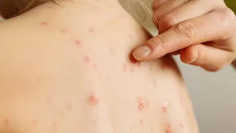 Sarampi&oacute;n. (Foto. Min Salud Chile).